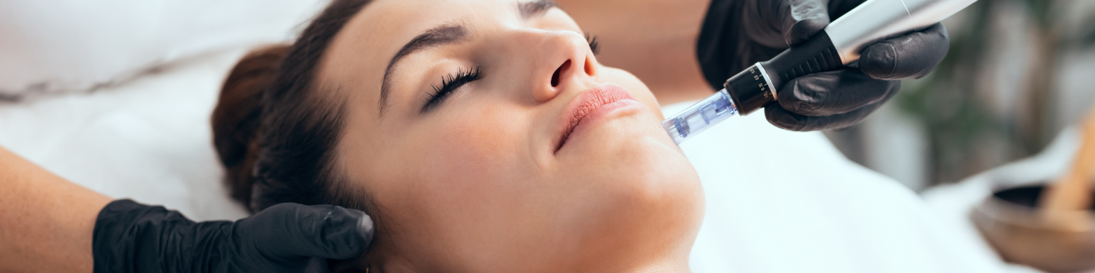Try Microneedling with SkinPen for Acne & Wrinkles