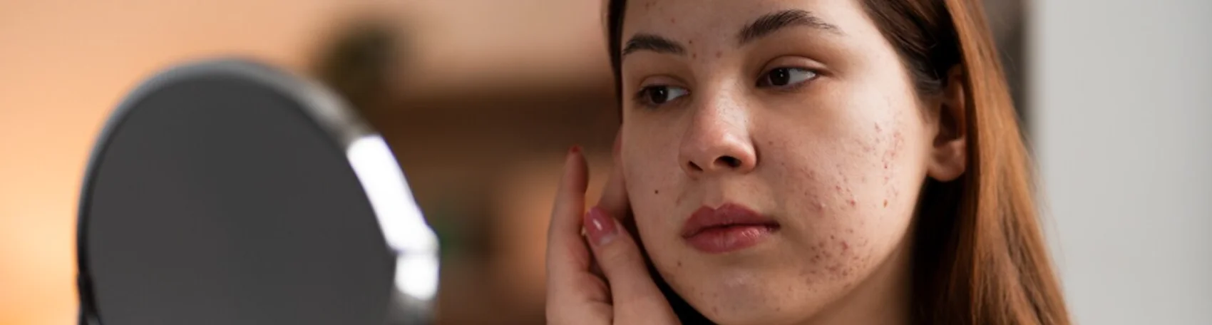 Chemical Peels for Acne Scars: How a VI Peel Can Improve Your Skin