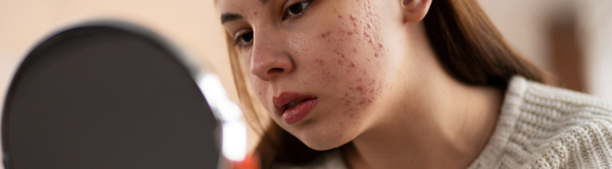 What Is the Best Treatment for Acne Scars?