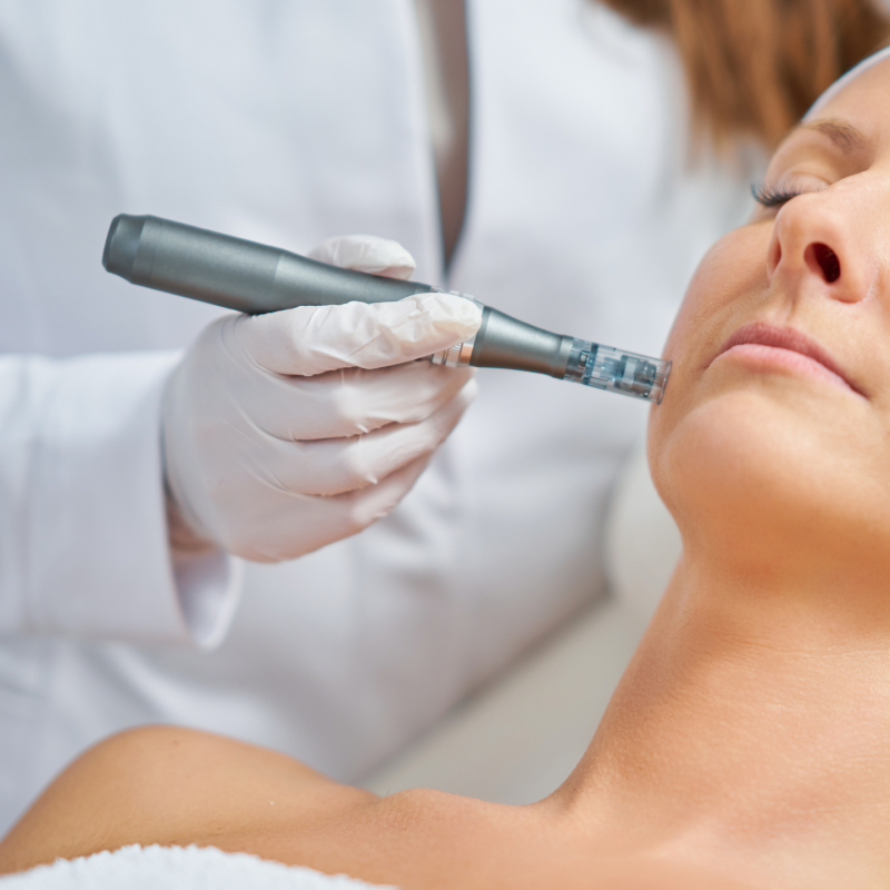 Microneedling with SkinPen: Benefits and Tips