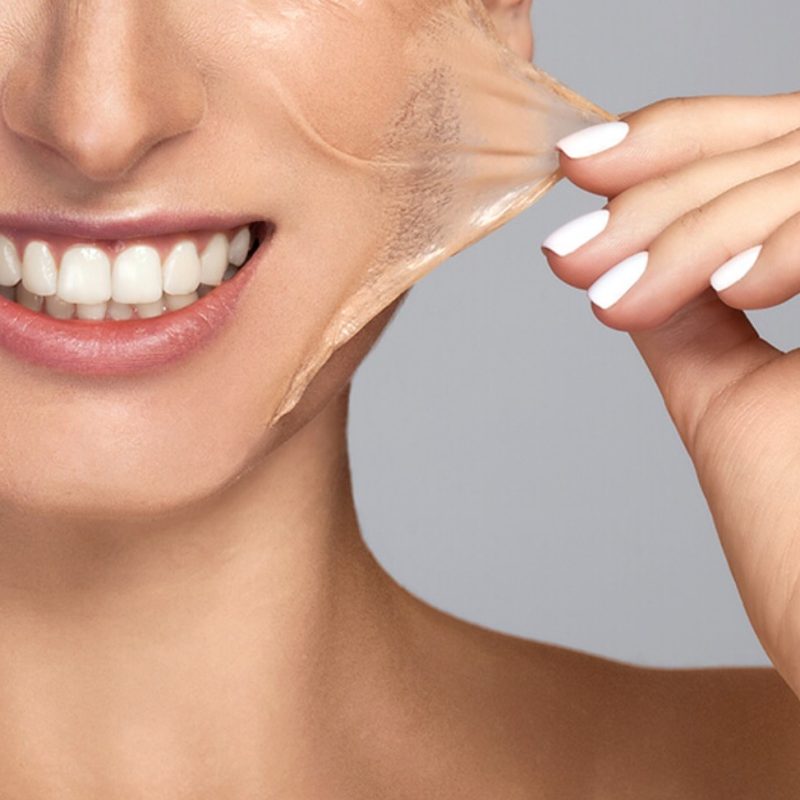 VI Chemical Peel
