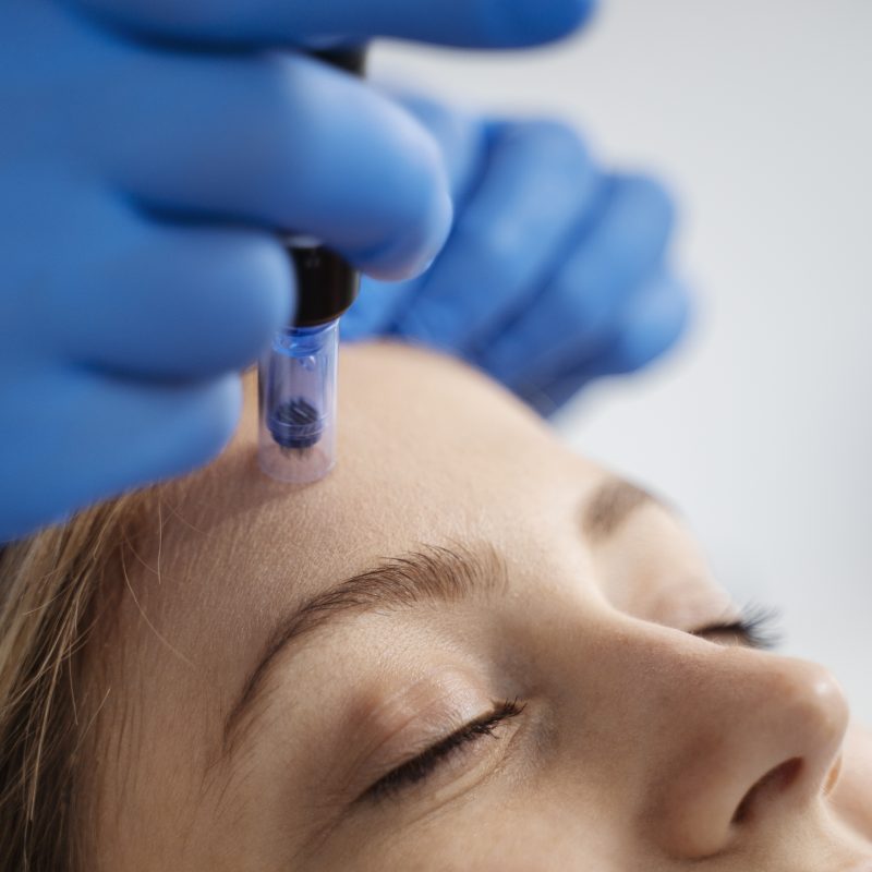 Best Microneedling Near Me Frisco Tx