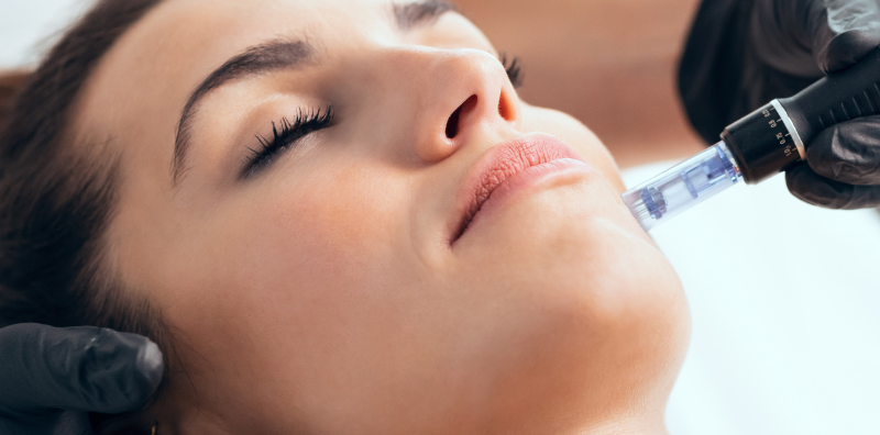 Try Microneedling with SkinPen for Acne & Wrinkles