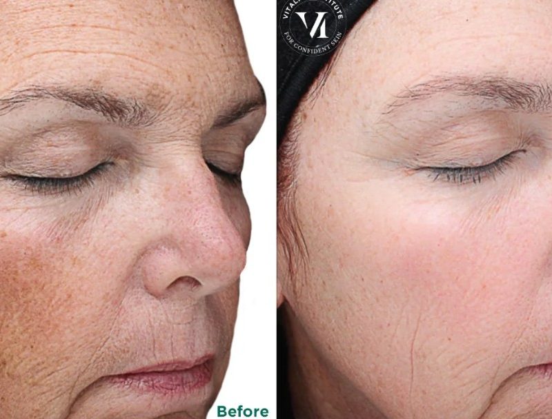 Chemical Peel near me