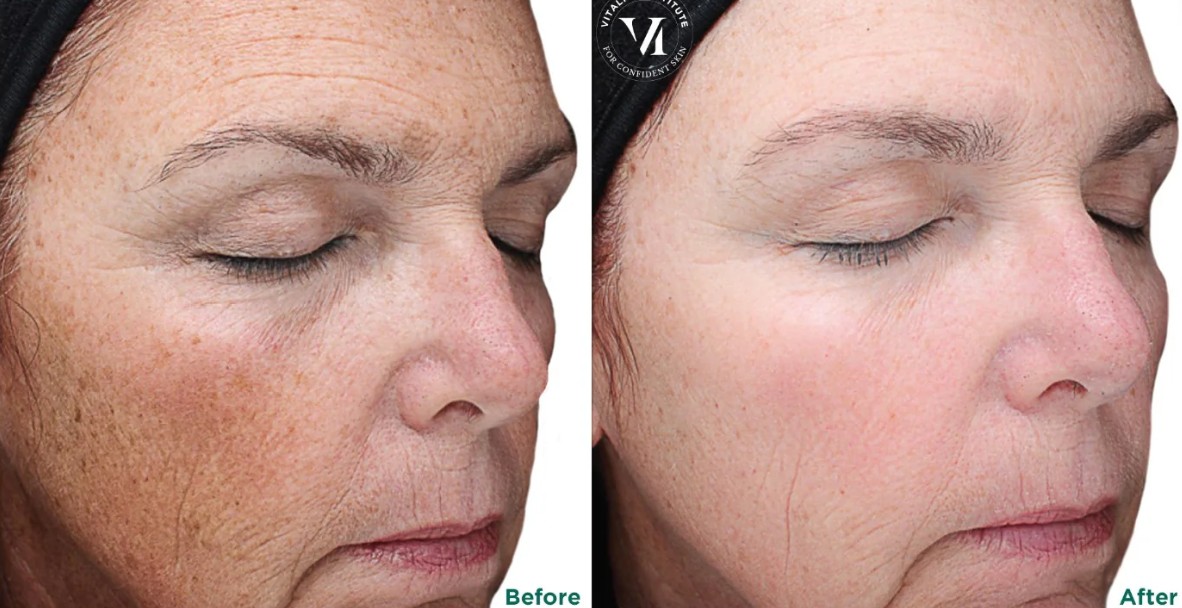 Chemical Peels for Acne Scars: How a VI Peel Can Improve Your Skin