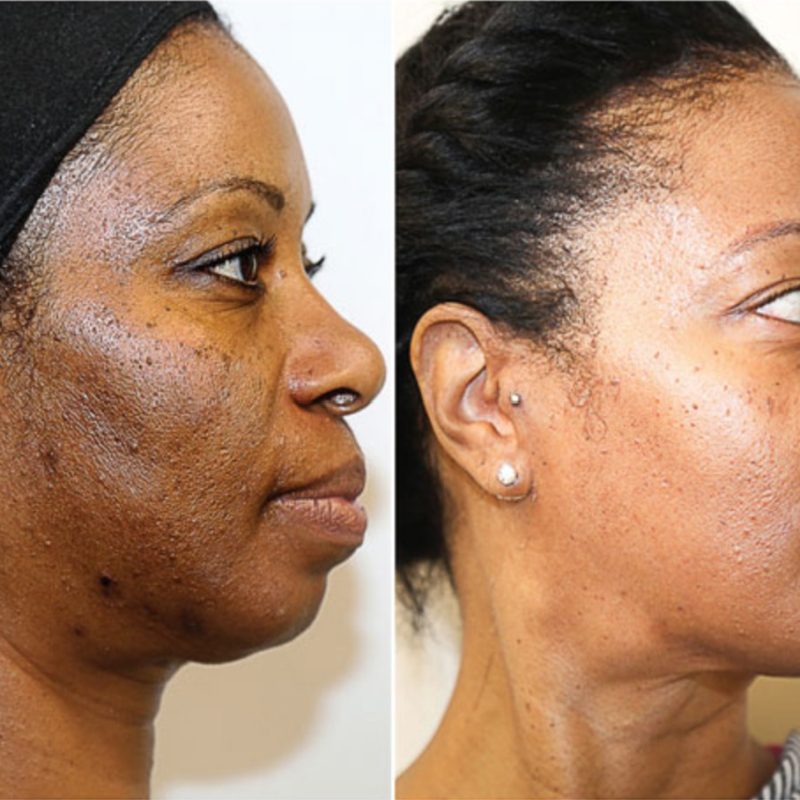 VI Peel Frisco Tx