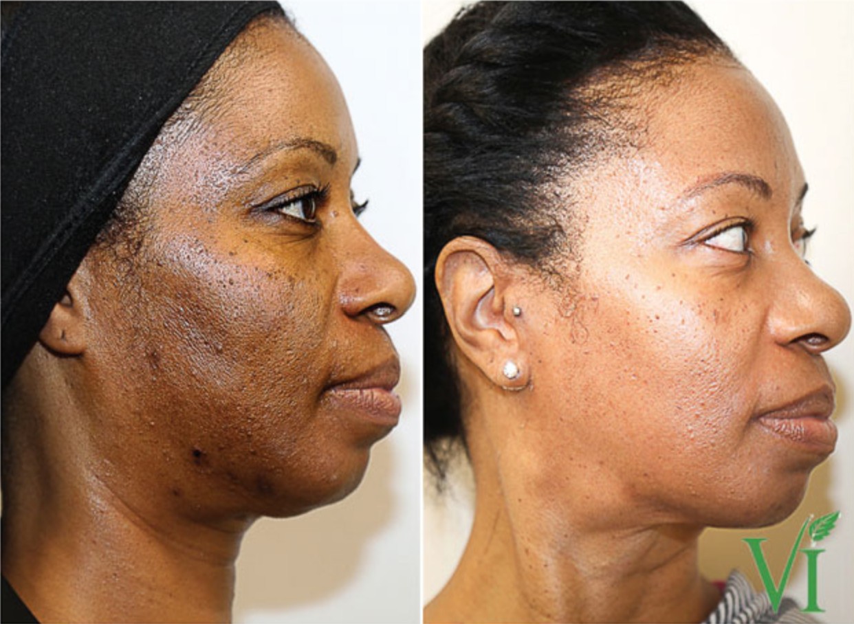 VI Peel Near Me: The Secret to Even-Toned, Glowing Skin